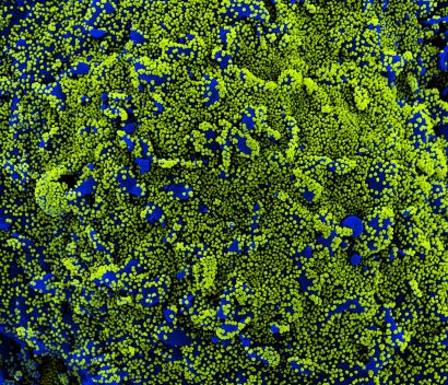 A cell infected with SARS-CoV-2 particles