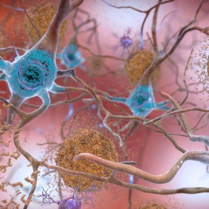 NIH The Alzheimer's disease brain, with build ups of tau protein on the inside and beta amyloid protein on the outside