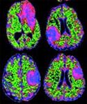 MRI Tumor Scans